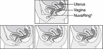 Illustration depicting how to insert the NuvaRing into the vagina.