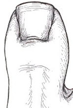 Image of properly trimmed toenail.